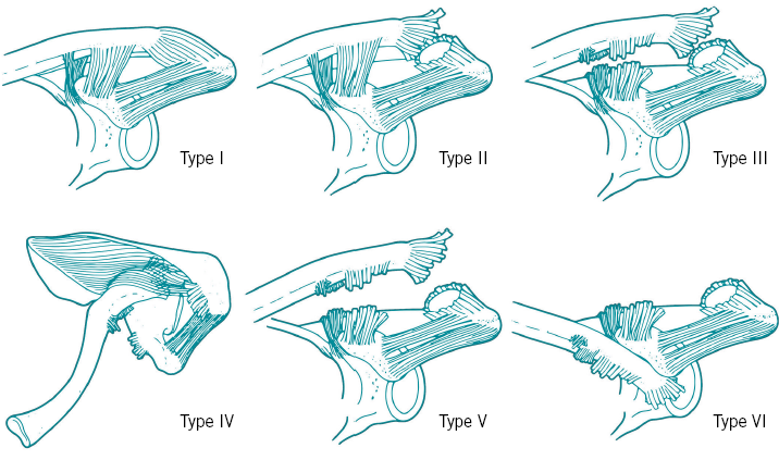 Figure 2 - Illustrations of Rockwood Classification types of AC injuries. 