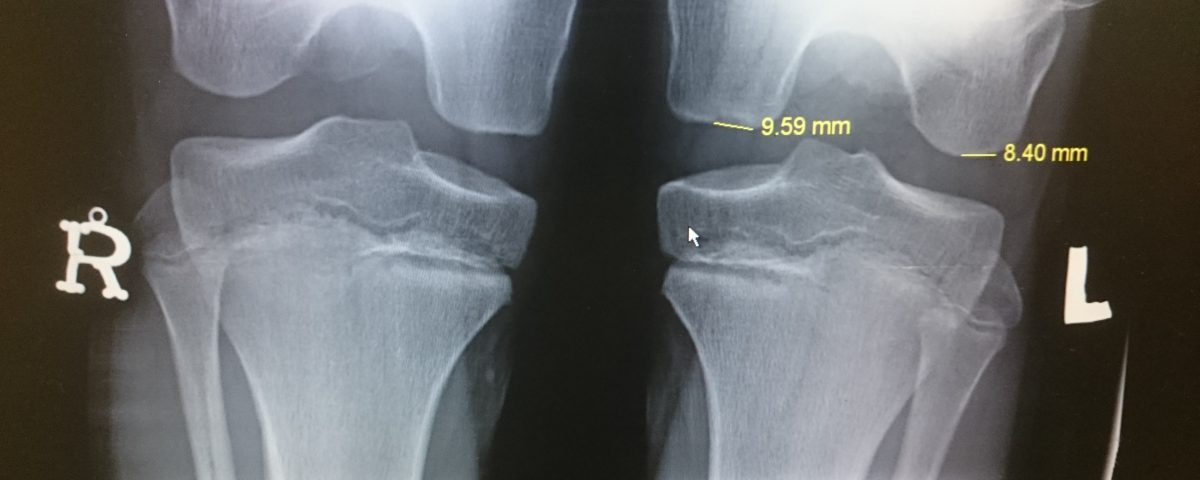 osteochondrosis online fájdalom a lapocka és a jobb oldali gerinc között