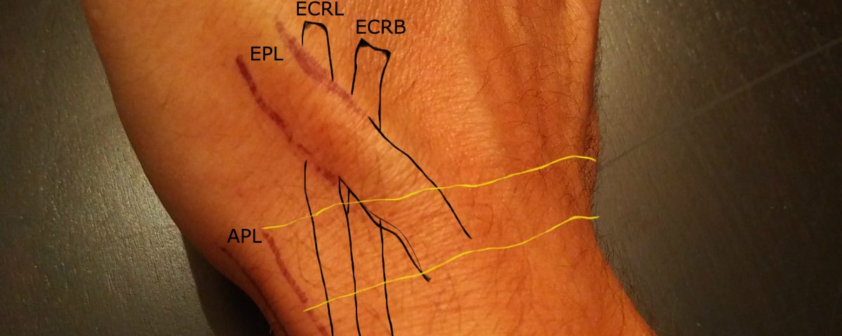 proximal intersection syndrome